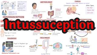Intussusception Explained Simply: Pathophysiology, Diagnosis & Management.