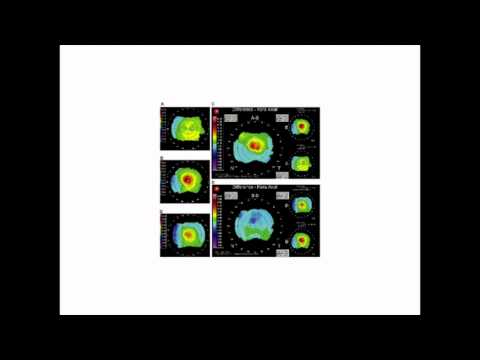 Video: Sikkerhed Og Effektivitet Af Den SUPRACOR Presbyopiske LASIK Algoritme På Hyperopiske Patienter