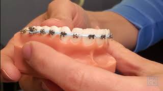 Parts of Braces and Aligners (Knowing the parts helps you communicate with your orthodontist better) screenshot 4