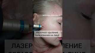 ВАУ!! ЛАЗЕРНОЕ УДАЛЕНИЕ  РОДИНОК НА ЛИЦЕ!!!