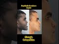 Antes e depois . Cirurgia ortognática
