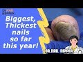 Why thick toenails?  Biggest, Thickest nails so far this year!  And a bonus Ram's Horn Toenail