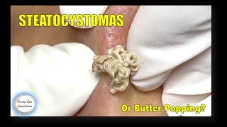 Compilation 08: Steatocystomas or Butter Popping? Face multiple dermal cysts!