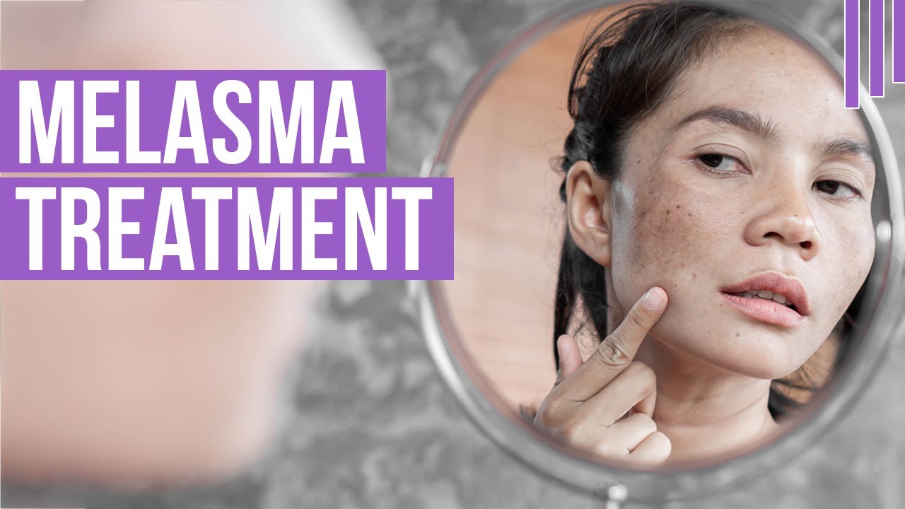 How Can You Do Melasma Treatment at Home