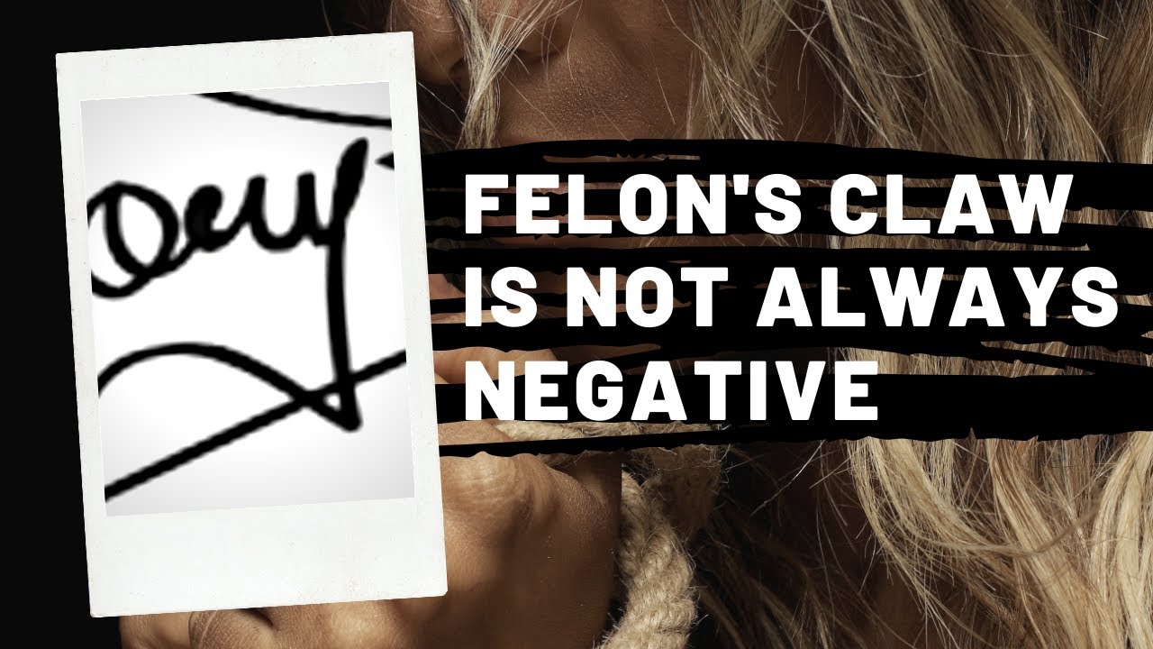 Felon's Claw Can Be a Positive Sign in Graphology 