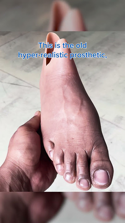 Formlabs Helps Sydney Get a Custom 3D-Printed Prosthesis
