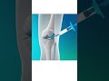 Route of injection name ?