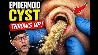 This Cyst Had a MOUTH… and Then It THREW UP 🤢