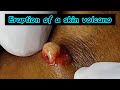 Relax your mind with popping of this creamy cyst dramazingskin