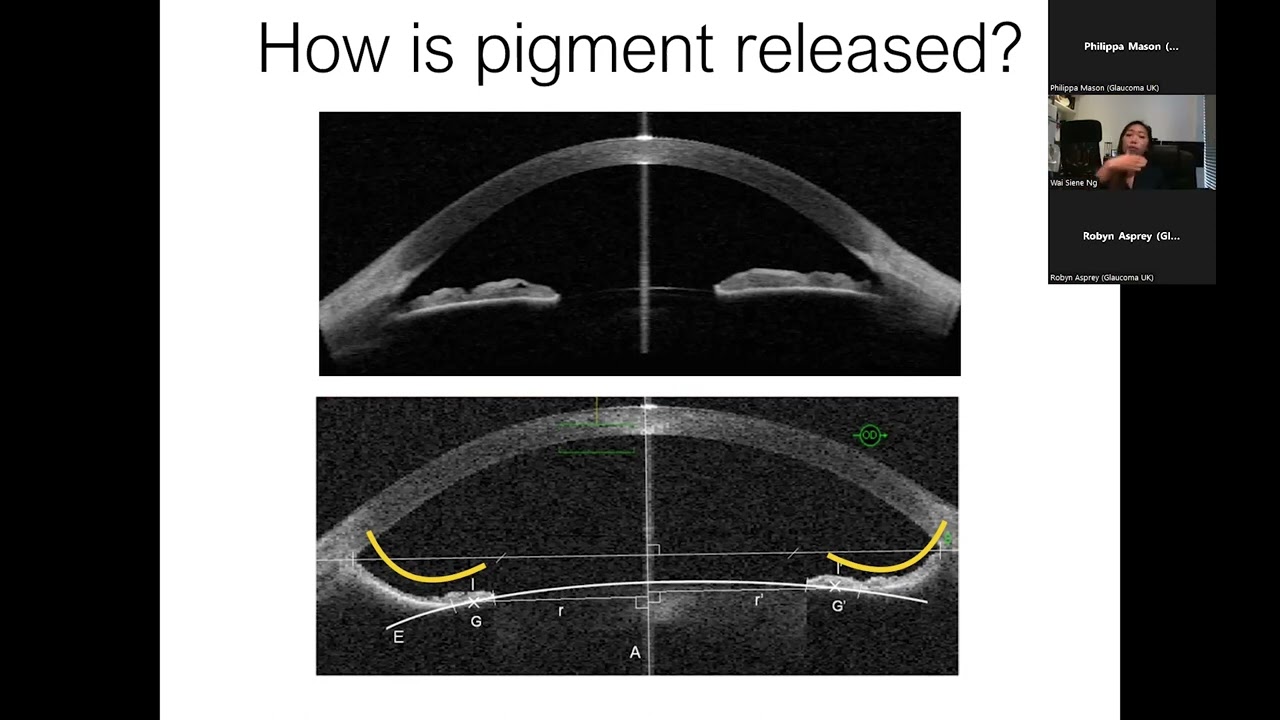 Glaucoma Support Group: Types of glaucoma - pigment dispersion