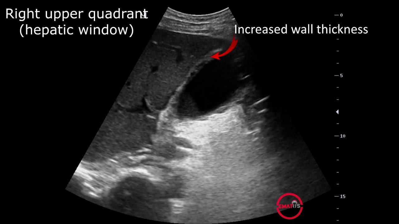 Emergency Point Of Care Ultrasound In Right Upper Quadrant Pain; CASE 2