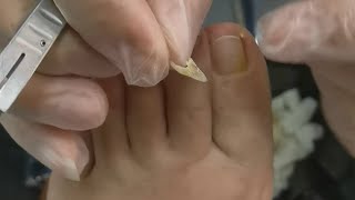 Yellow and rotten toenails, the doctor cleaned them up little by little.