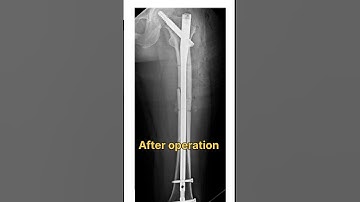 femur bone fracture #shorts #viral#new #shortvideo