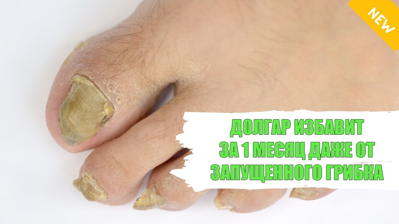 Самый эффективный препарат от грибка ногтей ног