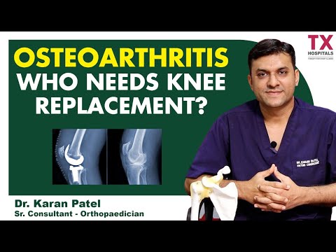 What Is Osteoarthritis | Who Needs Knee Replacement Surgery? | Dr. Karan Patel | TX Hospitals