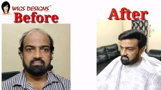 Hair Replacement at Hyderabad/Bangalore 9951223066