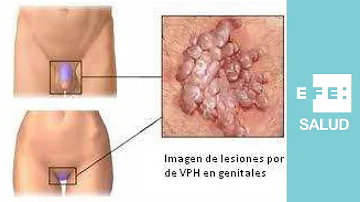 ¿Cuáles son los papilomas de alto riesgo?