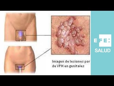 Vídeo: Infección Por El Virus Del Papiloma Humano: Síntomas Y Prevención