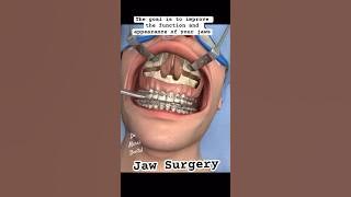 JAW SURGERY, UNDER BITE