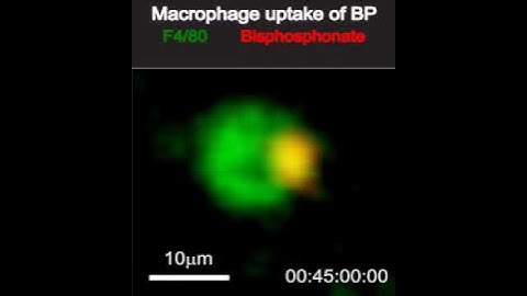 Macrophage devouring calcium-bisphosphonate complex