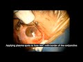 Pterygium Surgery Applying Plasma Spot Fuse AMT by PLEXR Plasma