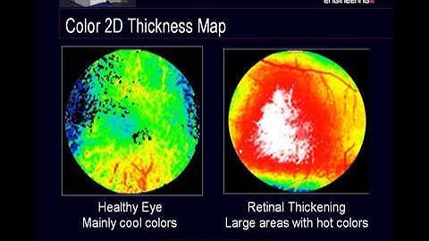 Optimal Techniques for Macula Imaging with the HRT