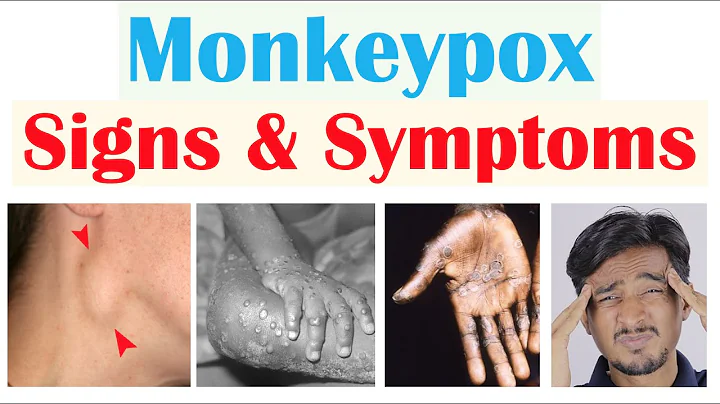 Monkeypox Signs & Symptoms (First Symptom & Stages of Rash) - DayDayNews