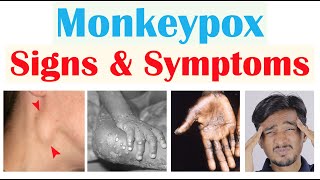 Monkeypox Signs & Symptoms (First Symptom & Stages of Rash)