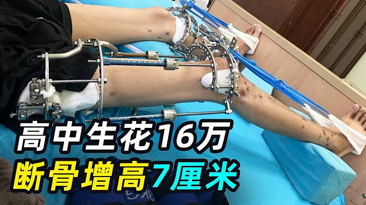 打断骨头再拉长！高中生花16万增高7厘米，锯断腿骨痛不欲生 - 天天要闻