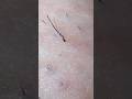 ﾌﾞﾖｯﾌﾟﾖﾌﾟﾖ#毛抜き #hairremoval