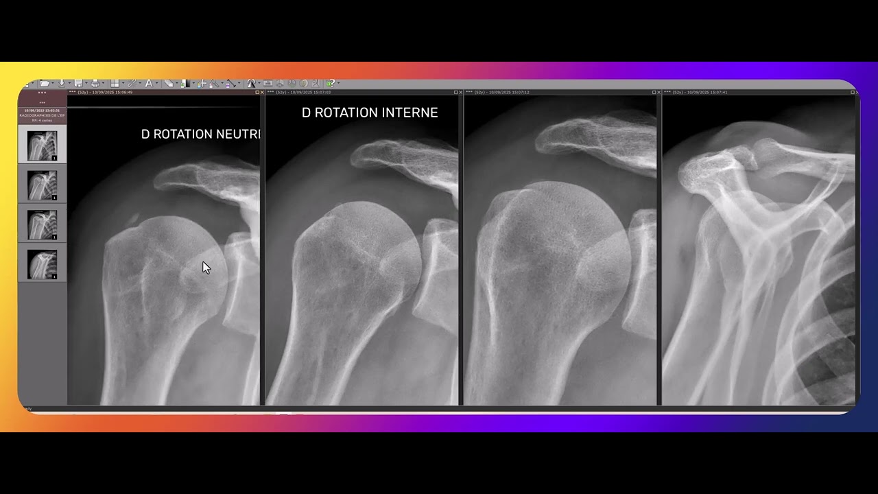 Tendinopathie calcifiante de la coiffe des rotateurs : exemple en radiographie.