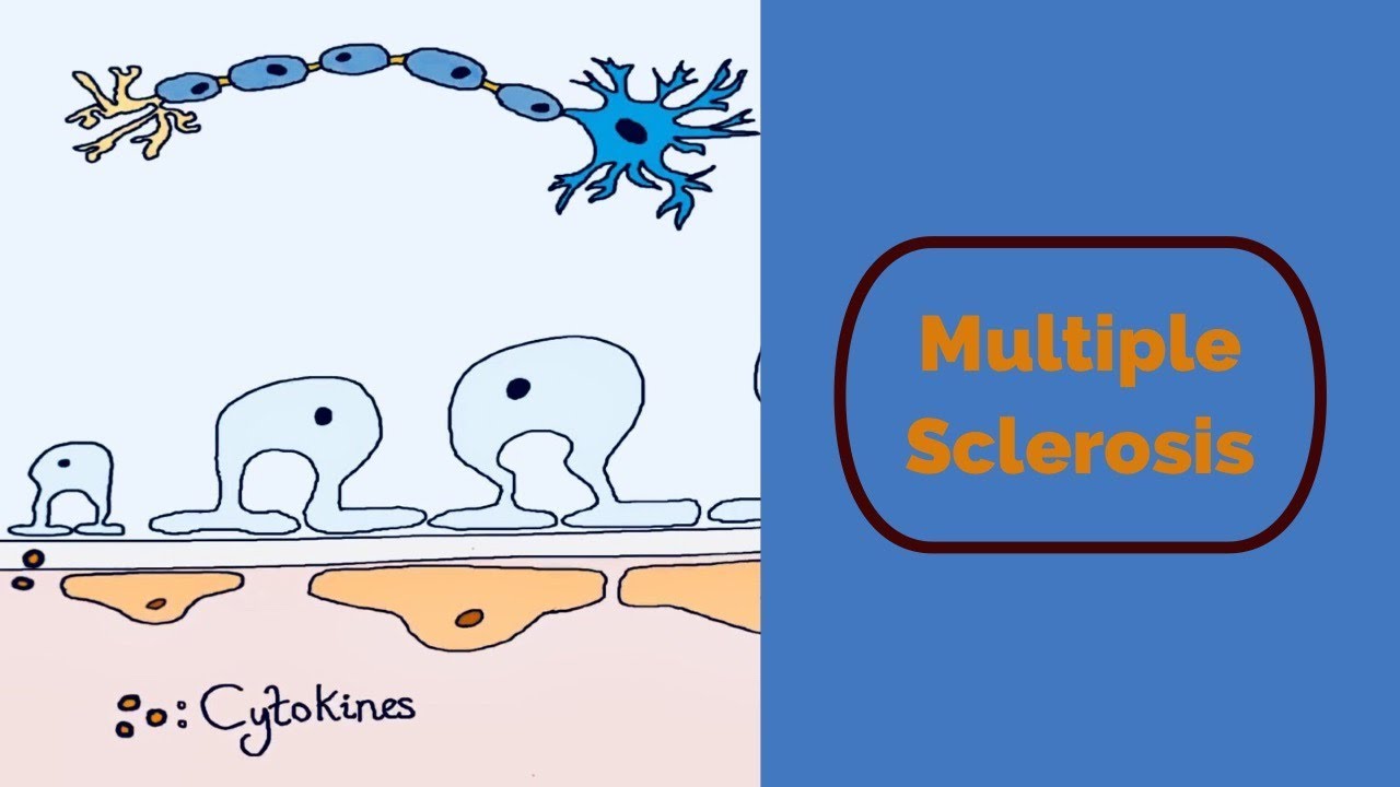 Sclerosis Multiplex, Csípőfájás sclerosis multiplex