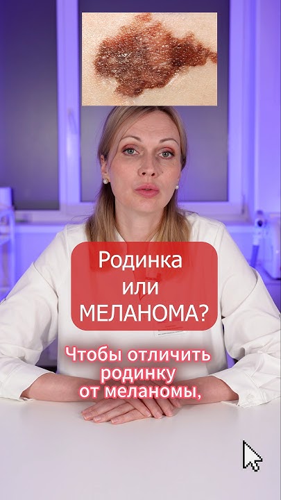 РОДИНКА или МЕЛАНОМА: КАК выглядит РАК КОЖИ? - YouTube