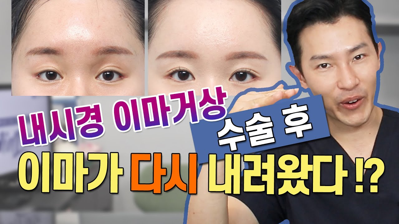 [미드라인]이마거상 수술 후 이마가 다시내려왔다!?