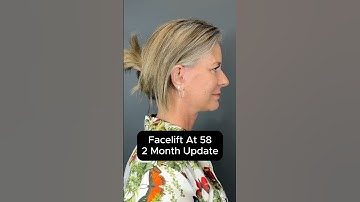 Facelift At 58 - 2 Month Update (Interview) #facelift