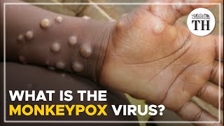 What is the monkeypox virus? | The Hindu