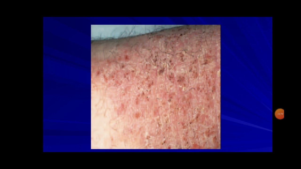 Allergic skin disease By Dr. Rasha Ismail YouTube