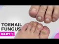 Got Rejected by a Podologist | Toenail Fungus Part 3