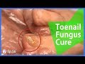 TOP MEDICAL PEDICURE Ep.56 - Young Man&#39;s Fungus Toe Get Cured