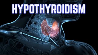 Hypothyroidism (updated 2023)  CRASH! Medical Review Series