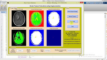 Brain Tumor Detection Using Segmentation Matlab Project with Source Code