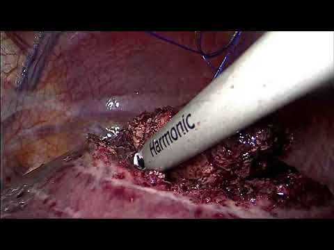 Laparoscopic Resection of Liver Segment 7 Colorectal Metastasis in Semi Prone Position