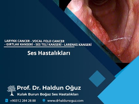 Larynx Cancer - Vocal Fold Cancer - Gırtlak Kanseri - Ses Teli Kanseri - Larenks Kanseri