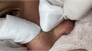 Blackhead Removal: Satisfying  Routine | 133