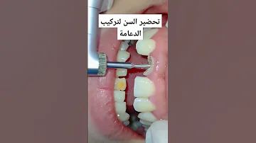 كيفية تحضير السن لتركيب دعامة الاسنان 