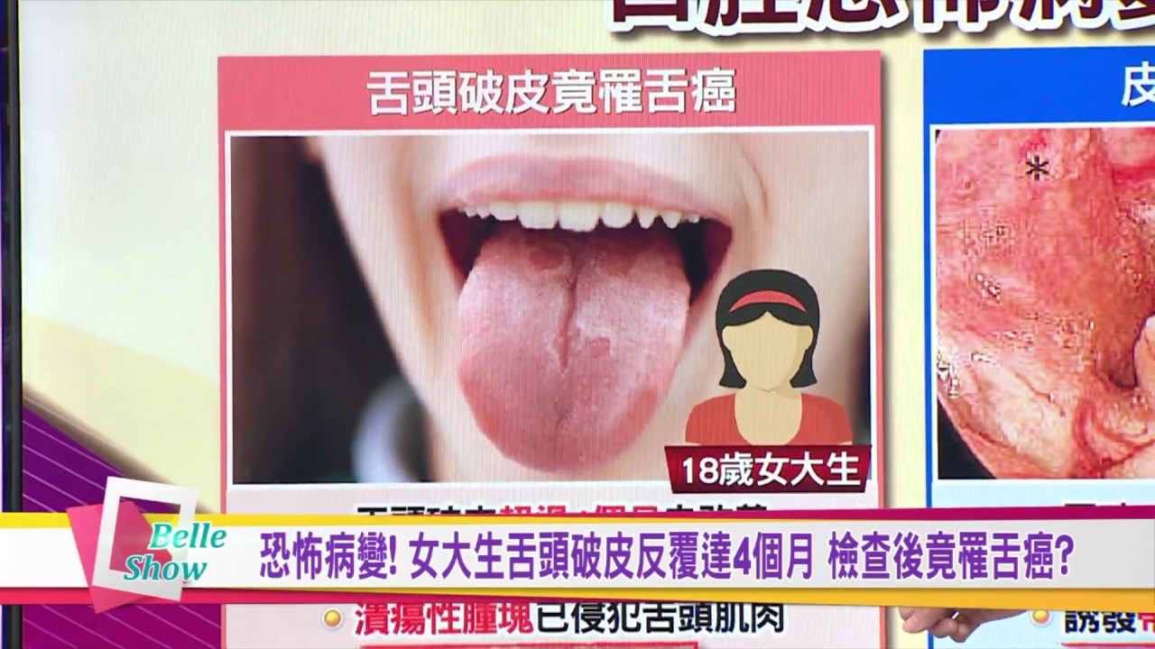 恐怖病變 女大生舌頭破皮反覆達4個月檢查後竟罹舌癌 國民大會 預告 Youtube