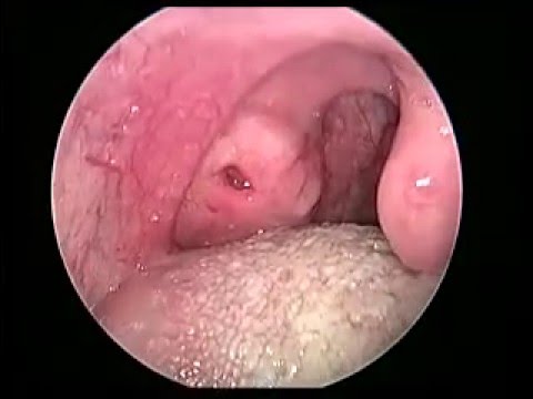 扁桃腺隱窩 Singacast