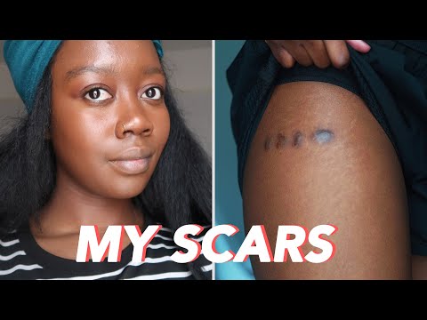 Why Does Dark Skin Scar Differently To Light Skin?