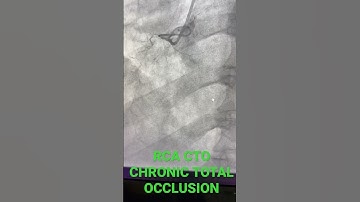 RCA CTO | Chronic Total Occlusion #shorts