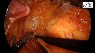 Laparoscopic low anterior resection